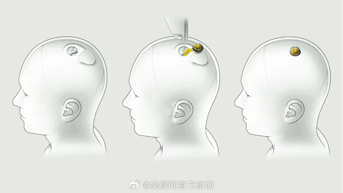 腦控芯片最新取出技術(shù)，心靈與自然的奇妙之旅